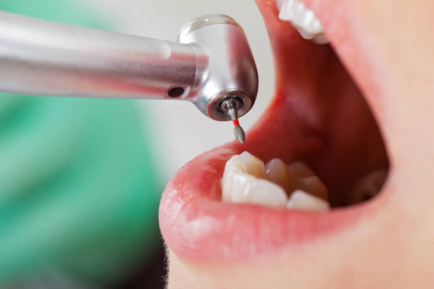Best Emergency Wisdom Teeth Removal in Coing, AL